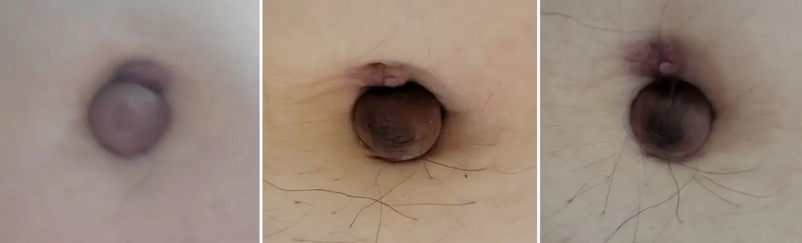 배꼽-치료-시간-경과-사진